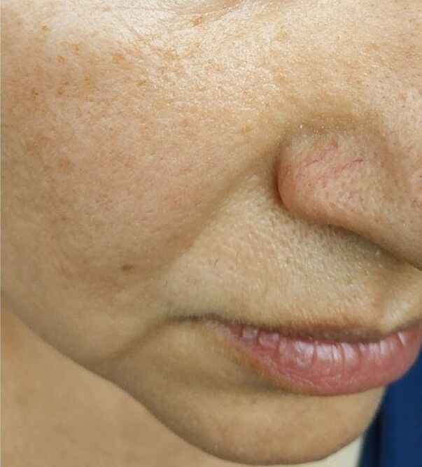 At the age of 40, nasolabial folds appeared. 