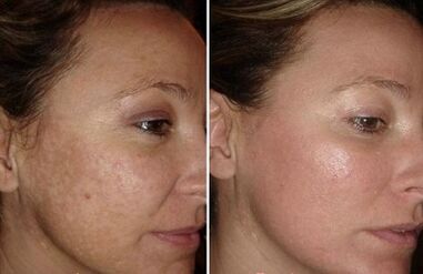 laser facial rejuvenation before and after photos